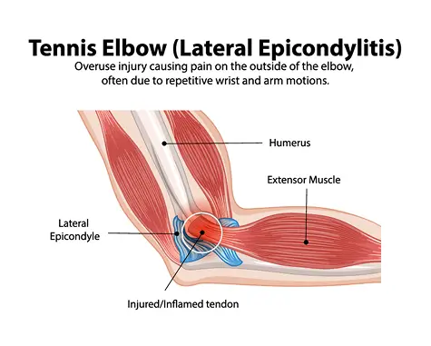 Medical diagram of tennis elbow (lateral epicondylitis) showing the affected tendons and muscles on the outside of the elbow, illustrating symptoms and causes treated at California Joint Pain Institute in Irvine, CA.