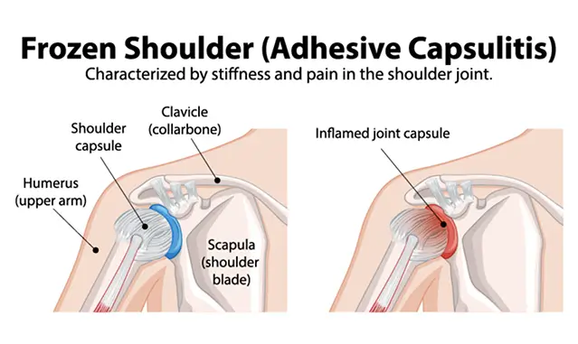 Medical anatomical diagram of Frozen Shoulder (Adhesive Capsulitis) comparing a healthy shoulder joint to an inflamed one.