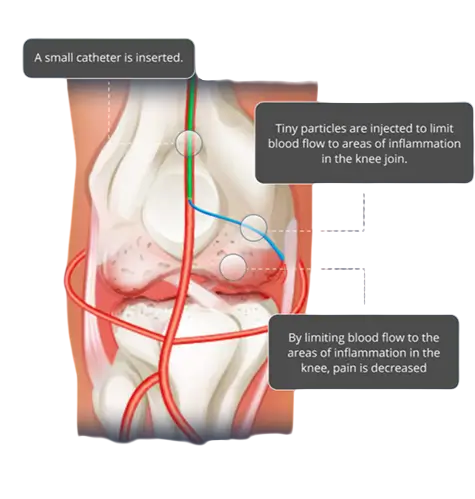 An instructional medical diagram illustrating how Genicular Artery Embolization (GAE) works.